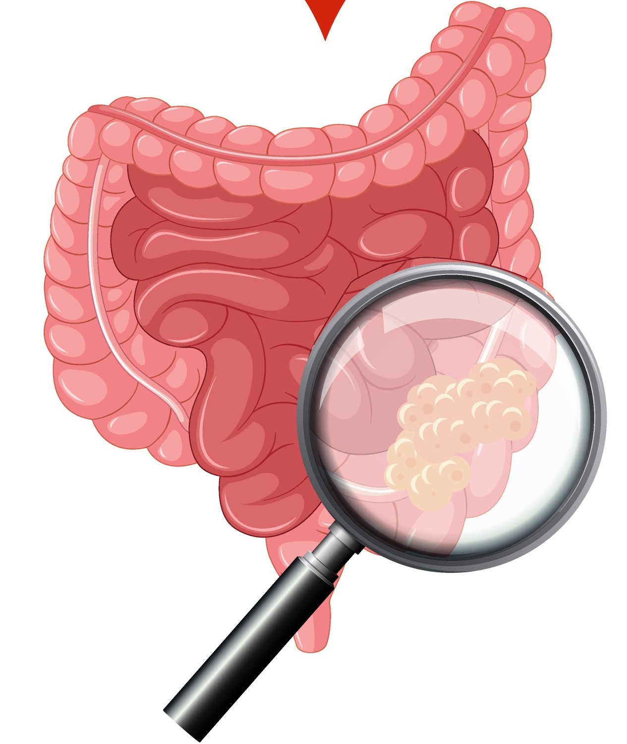 Molecular and Pathology Features of Colorectal Tumors and Patient Outcomes Are Associated with Fusobacterium nucleatum and Its Subspecies animalis
